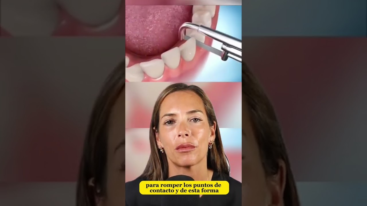 te liman los dientes despues de los brackets