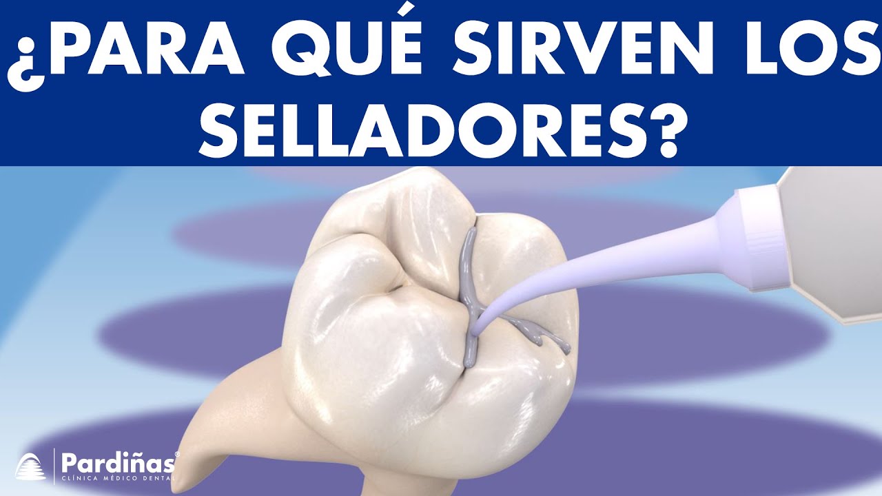 tipos de selladores de fosetas y fisuras