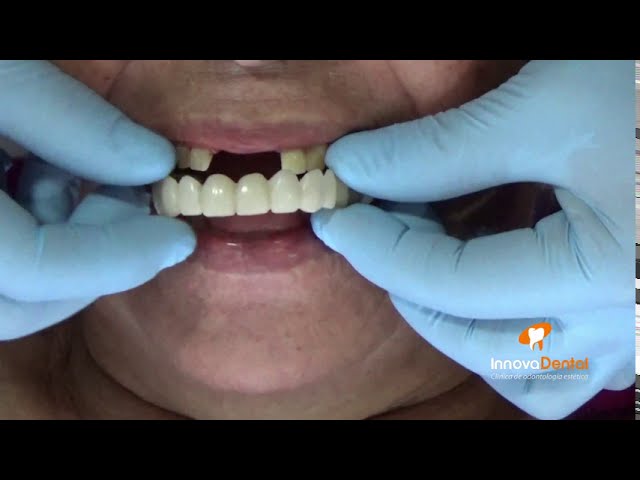 cambia la cara con dentadura postiza