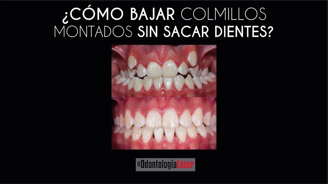 como bajar los colmillos sin aparatos