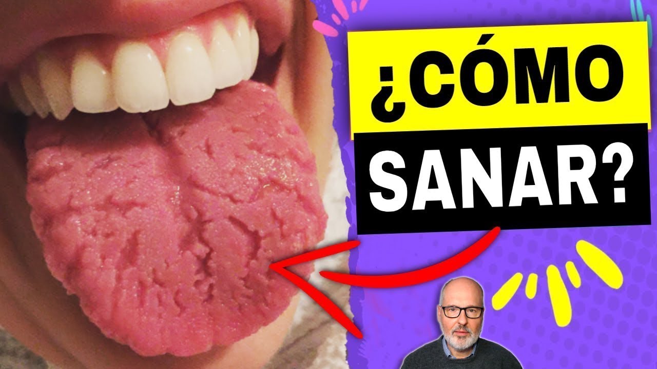 como quitar las grietas de la lengua