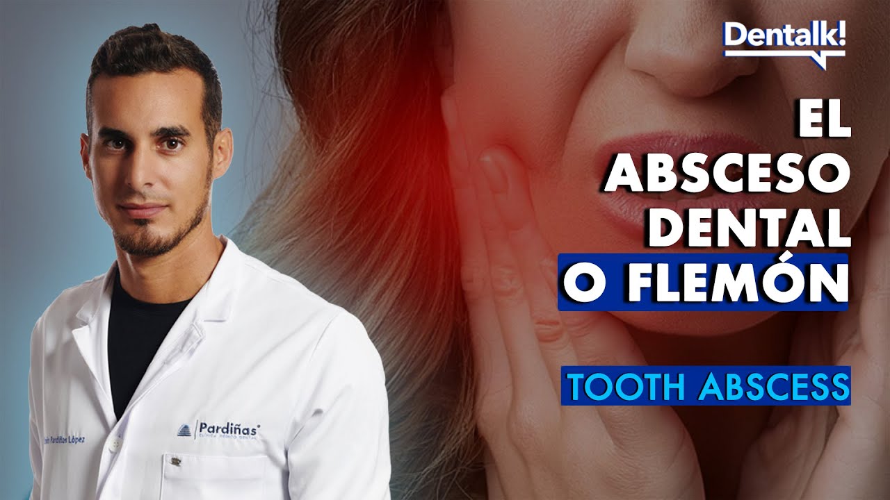 cuanto dura un flemon de muelas