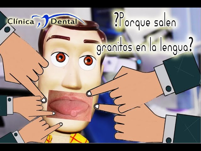 grano blanco en la punta de la lengua