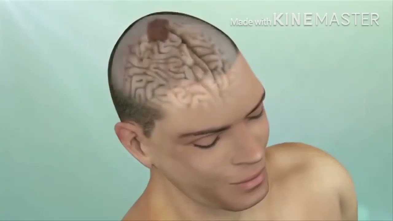 hendidura en la frente sin golpe