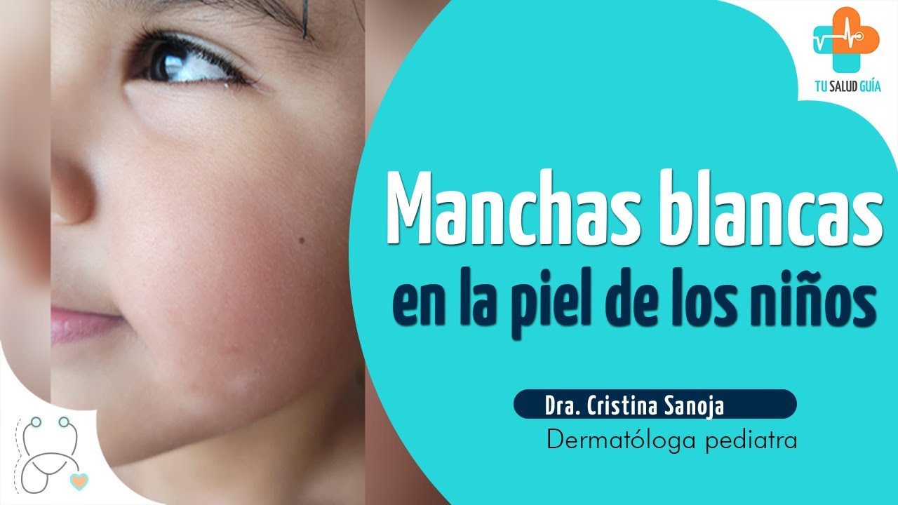 manchas blancas en la cara niños