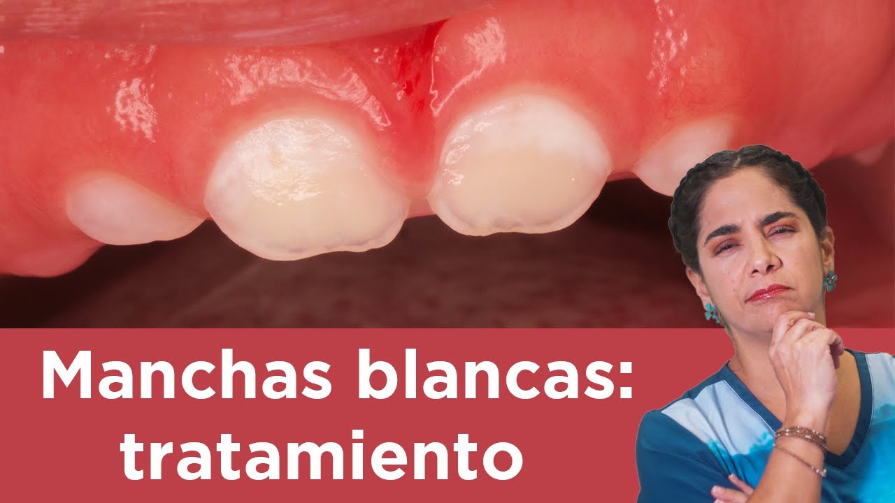 manchas blancas en los dientes en niños tratamiento