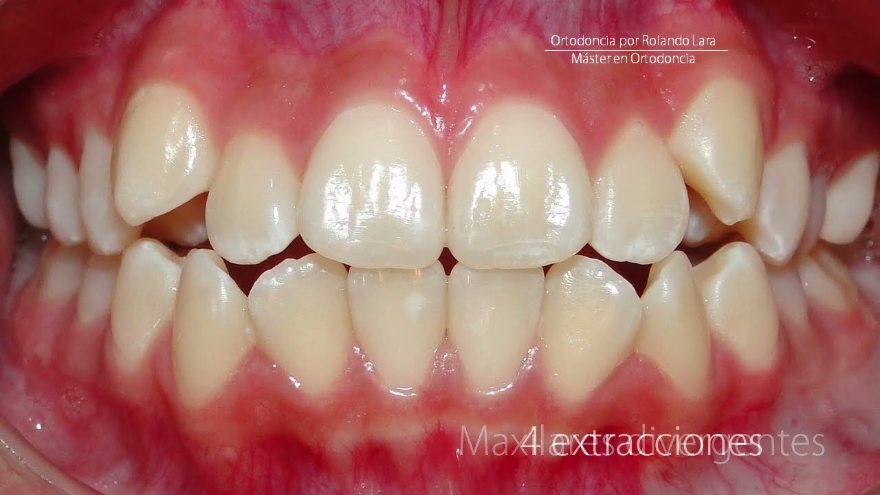 no me gustan mis dientes despues de la ortodoncia