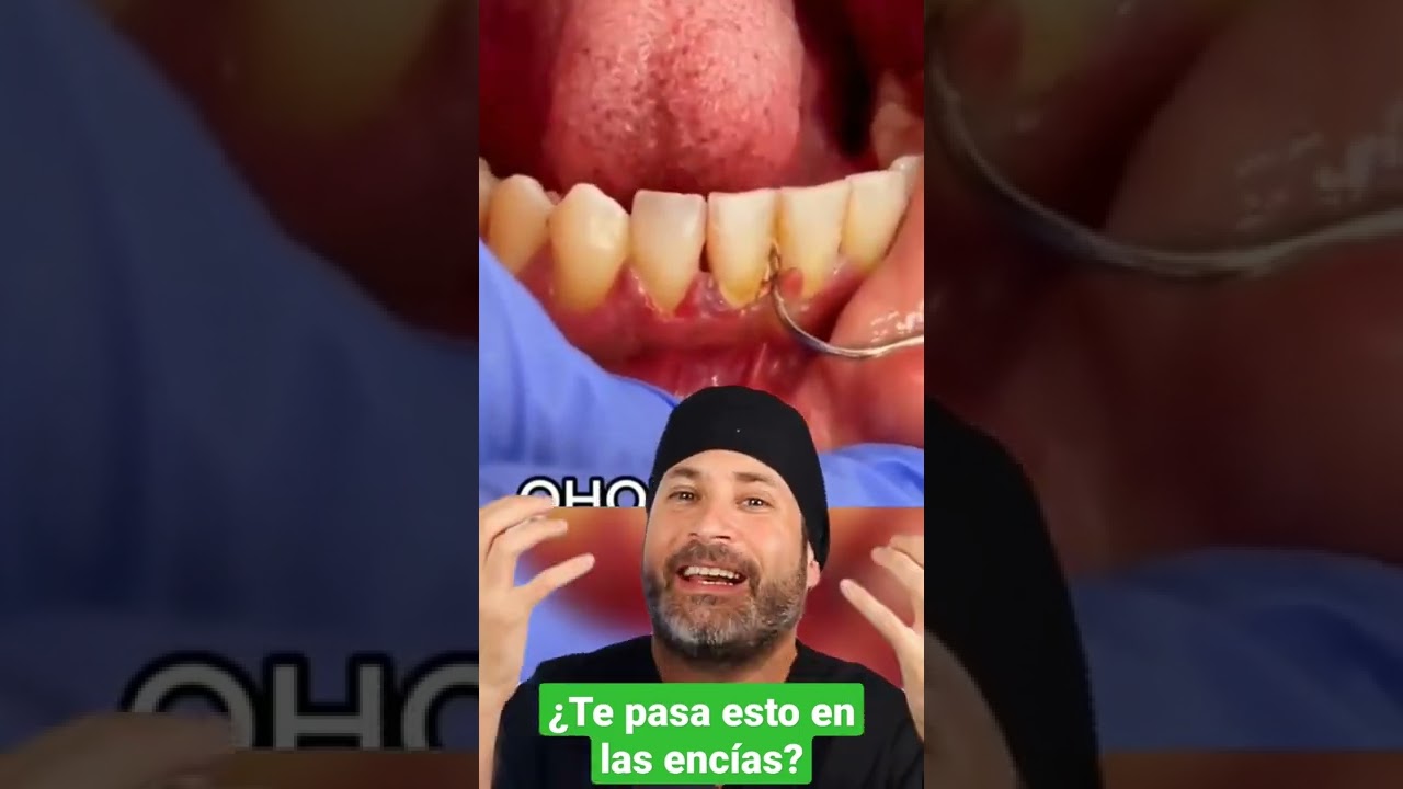 que pasa si se me cae un trozo de sarro