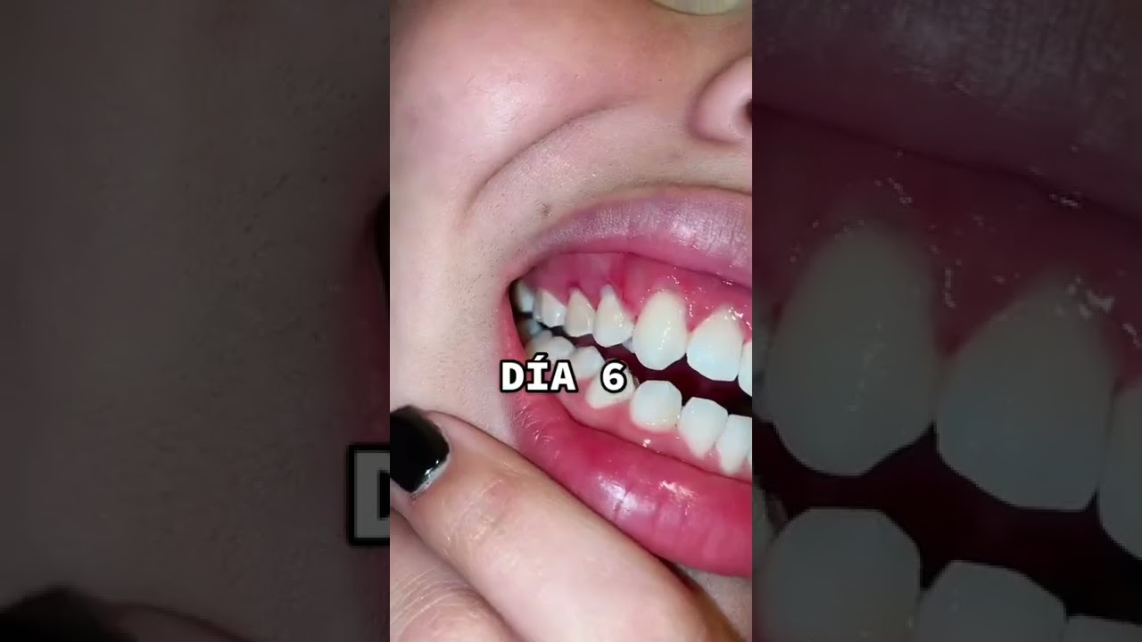 recorte de encia antes y despues