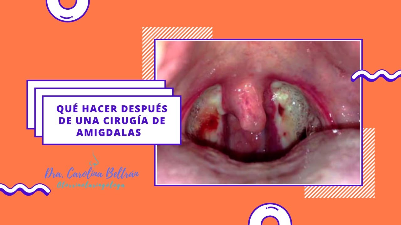 remedios caseros para después de operación de amígdalas