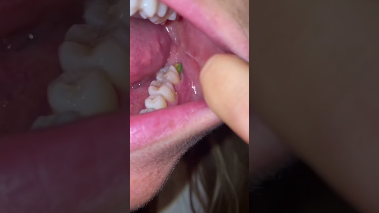 se me inflamo la encía detrás de la muela