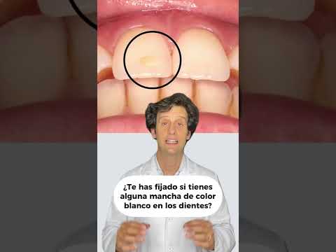tipos de manchas blancas en los dientes